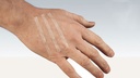 Sterile Wound Closure Strips